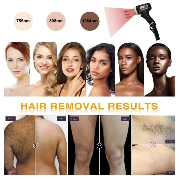 Diode Laser Hair Removal Machine